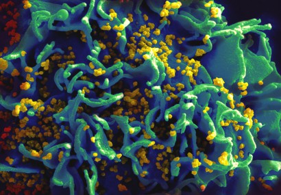 A HIV vírus elektronmikroszkópos képe