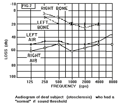 Audiogram: a páciens légvezetéses hallása jelentősebb, a csontvezetéses hallása kisebb mértékű eltérést mutat