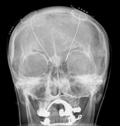 Parkinson-kóros beteg az agyba ültetett elektródákkal – a fehér tárgy a szájban egy fém műfogsor