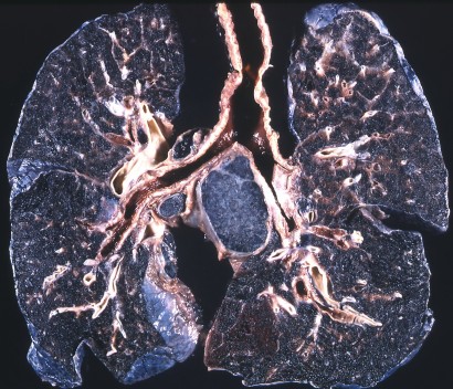 Szénybányász tüdeje: a pneumokoniózis klasszikus esete